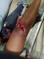 Bipasha's Leg Injury